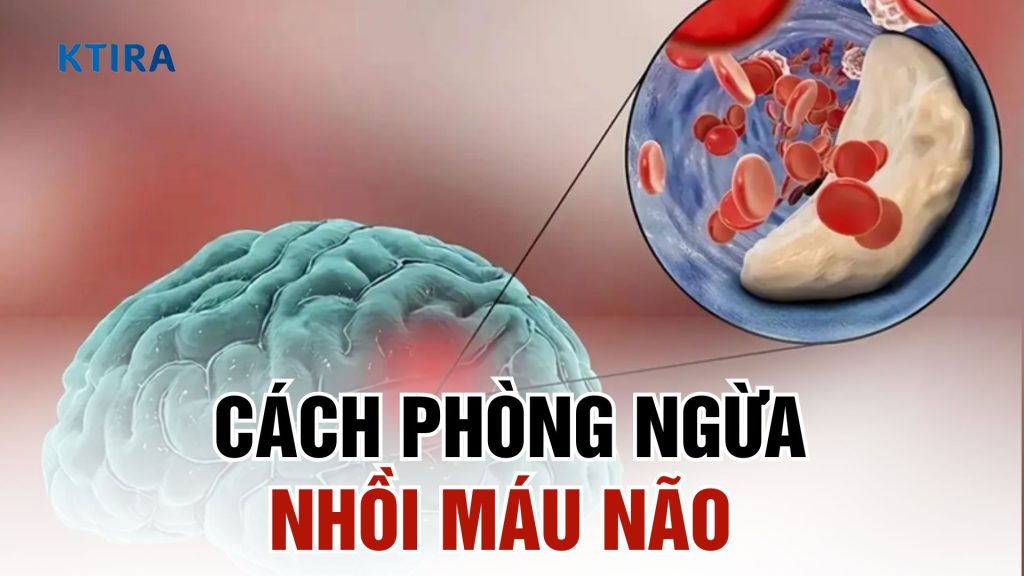 Cách phòng ngừa nhồi máu não