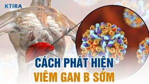 3 cách phát hiện viêm gan B sớm