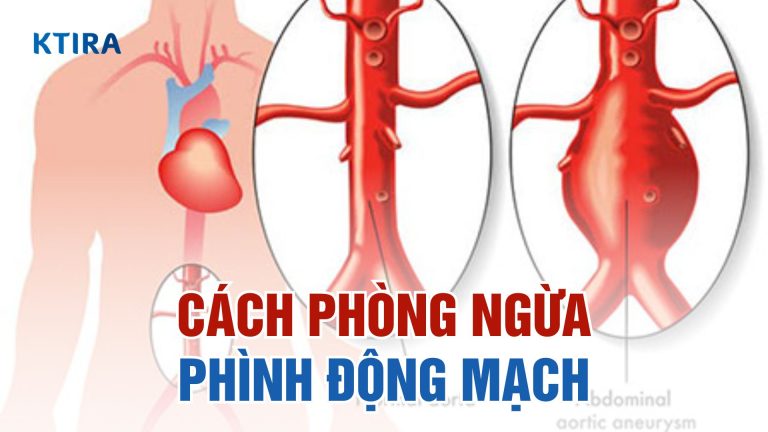 Bật Mí 4 Cách Phòng Ngừa Phình Động Mạch Và Bảo Vệ Sức Khỏe Tim