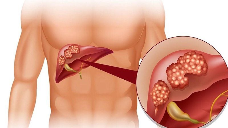 3 cách phát hiện sớm viêm gan B