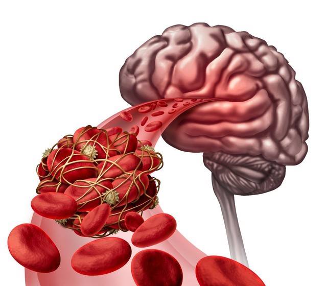 Những yếu tố nguy cơ đột quỵ