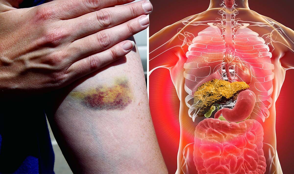 Triệu chứng gan nhiễm độc