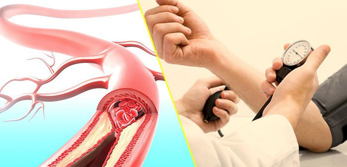 Những yếu tố nguy cơ đột quỵ