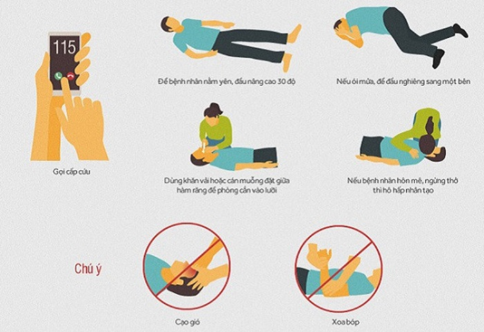 Quy trình sơ cứu đột quỵ