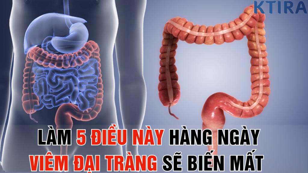 Làm 5 Điều Này Hàng Ngày Viêm Đại Tràng Sẽ Biến Mất