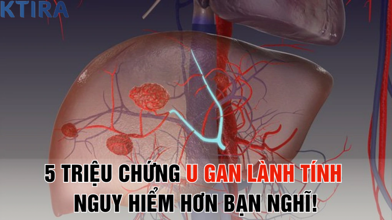 Đau Bụng, Mệt Mỏi? 5 Triệu Chứng U Gan Lành Tính Bạn Đang Bỏ Qua Có Thể Nguy Hiểm Hơn Bạn Nghĩ!