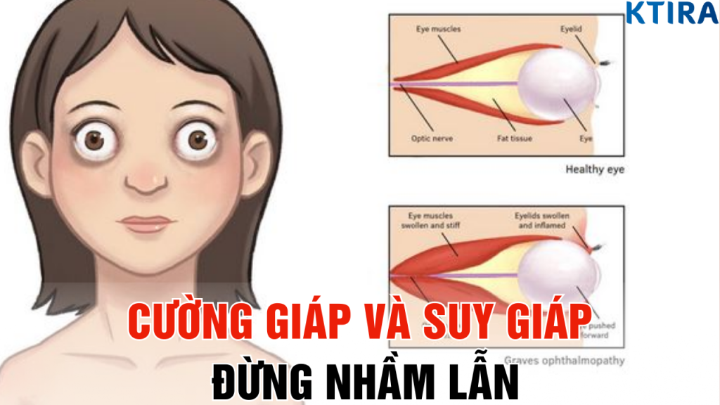 Cường Giáp Và Suy Giáp: 80% Người Việt Đang Nhầm Lẫn