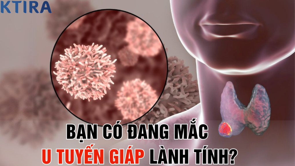 Bạn Có Đang Mắc u tuyến giáp lành tính?