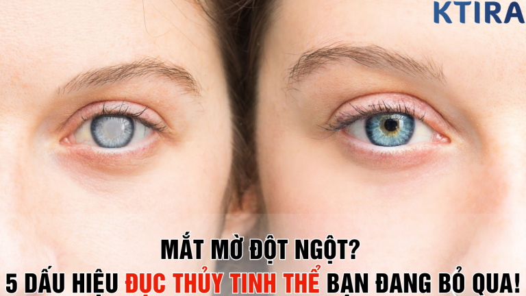 Mắt Mờ Đột Ngột? 5 Dấu Hiệu Đục Thủy Tinh Thể Bạn Đang Bỏ Qua Có Thể Khiến Bạn Mù Lòa!