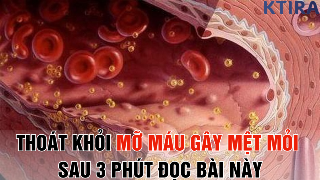 Bạn Sẽ Thoát Khỏi Mỡ Máu Gây Mệt Mỏi - Chỉ Sau 3 Phút Đọc Bài Này