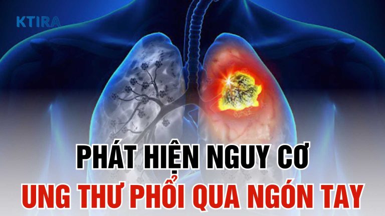 Phát Hiện Nguy Cơ Ung Thư Phổi Chỉ Trong 5 Giây Qua Ngón Tay!