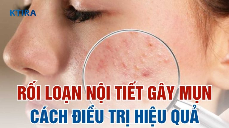 Nguyên nhân rối loạn nội tiết gây mụn và 4 cách điều trị hiệu quả