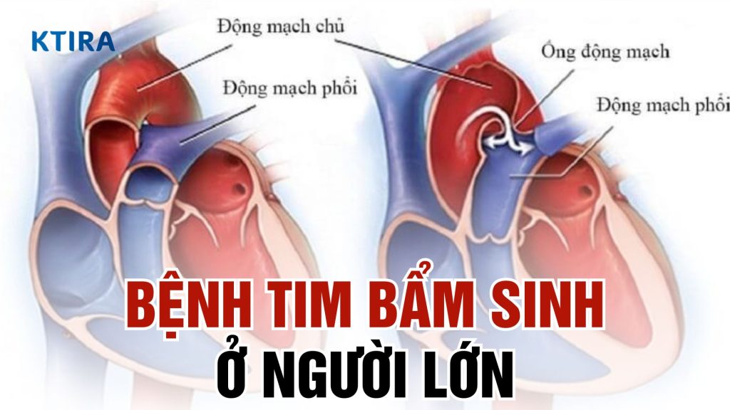 Bệnh tim bẩm sinh ở người lớn