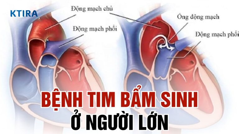 Bệnh Tim Bẩm Sinh Ở Người Lớn – 5 Điều Có Thể Bạn Chưa Biết!