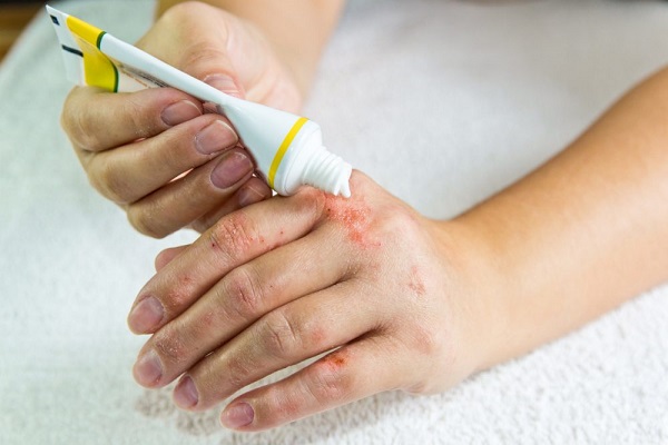Dấu hiệu viêm da dị ứng