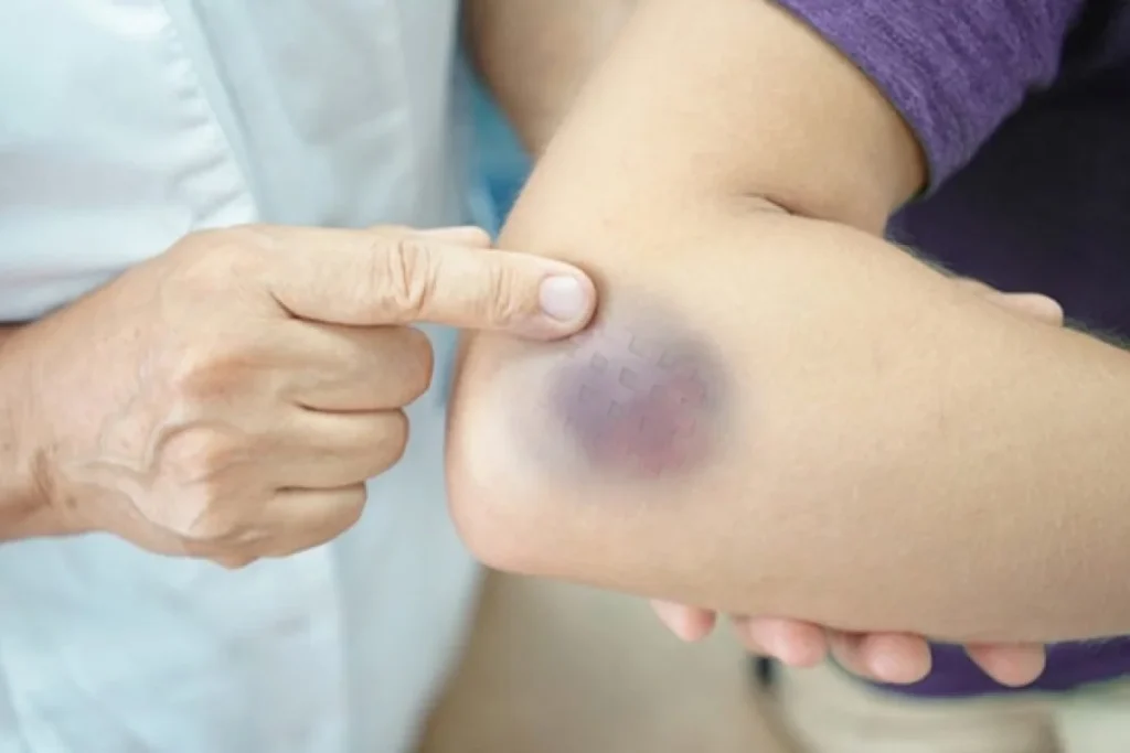 Các vết bầm tím bí ẩn