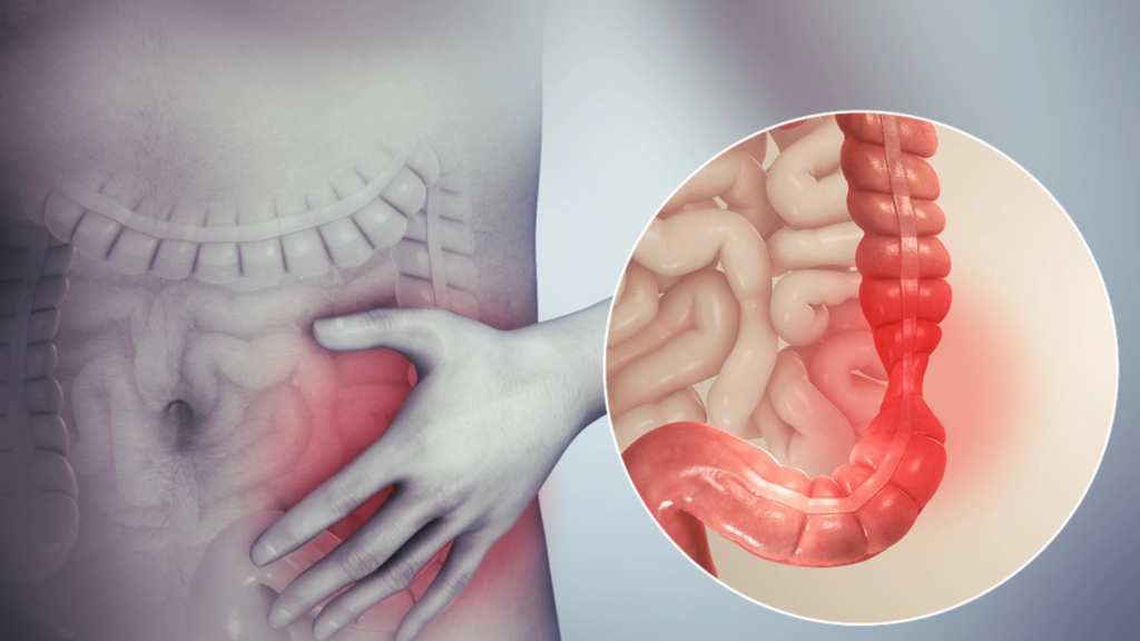 Viêm Đại Tràng Là Gì?