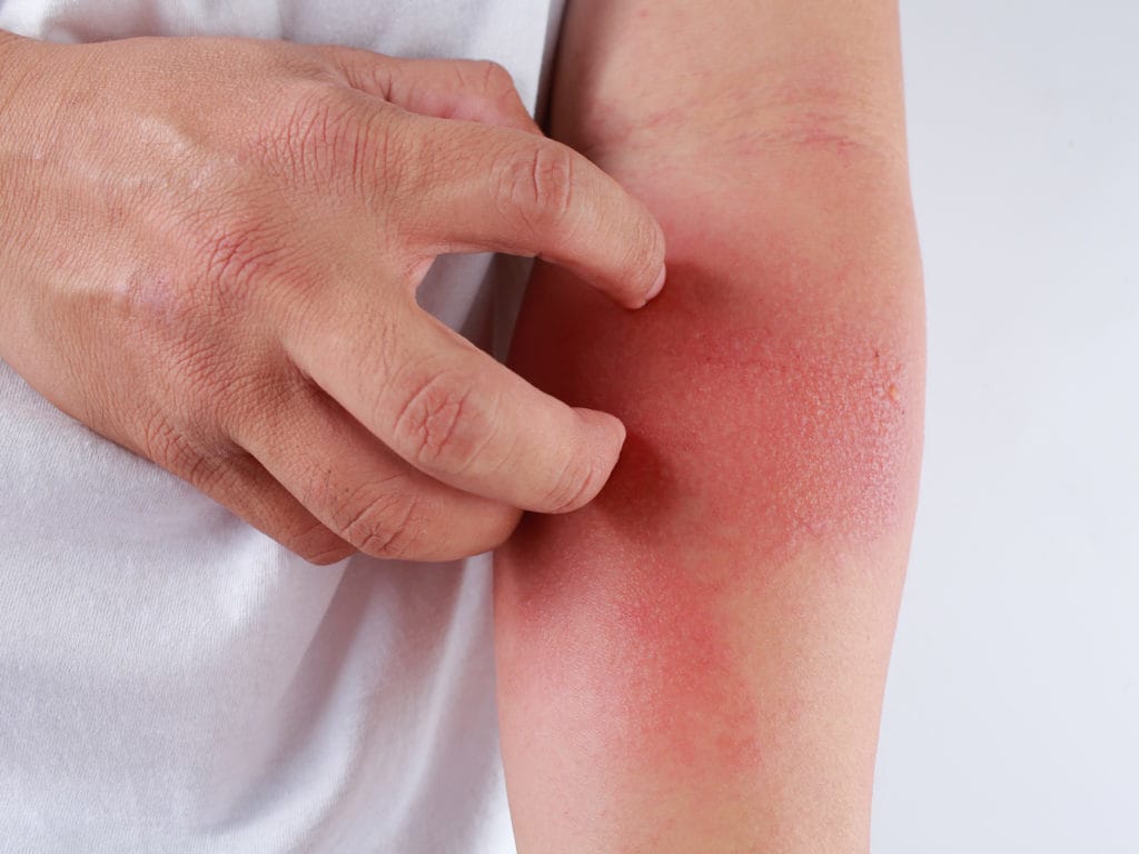Dấu hiệu viêm da dị ứng