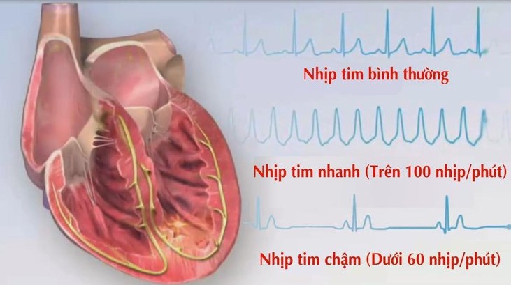 Tìm hiểu về rối loạn nhịp tim