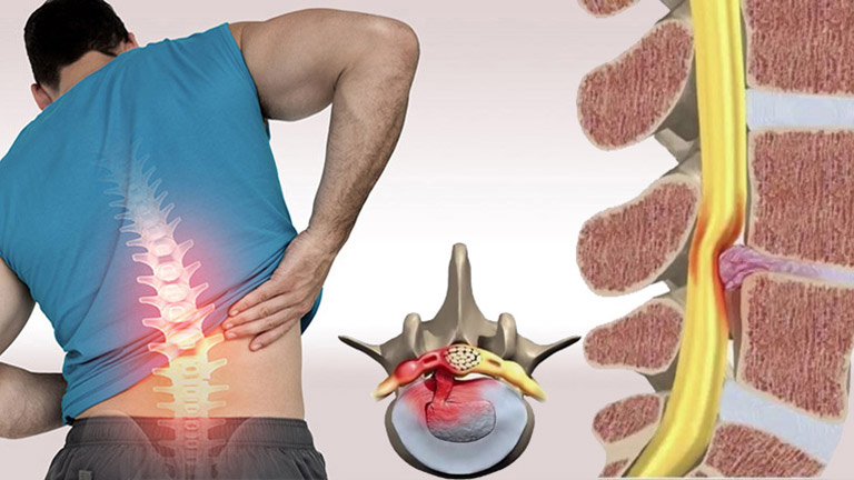 Dấu hiệu thoát vị đĩa đệm