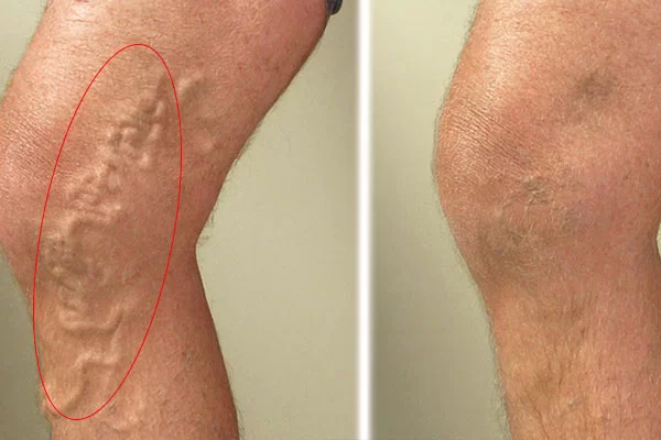 Dấu Hiệu Nhận Biết Bệnh Suy Giãn Tĩnh Mạch KTIRA