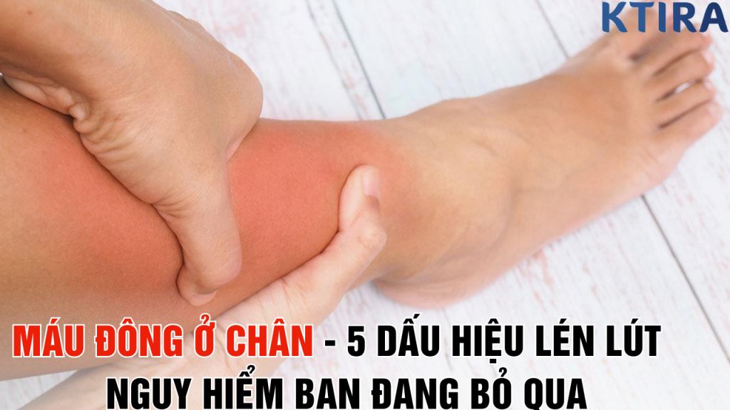 Máu Đông Ở CHÂN - 5 Dấu Hiệu Lén Lút nguy hiểm Bạn Đang Bỏ Qua