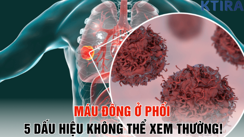 Máu Đông Ở Phổi 5 Dấu Hiệu Không Thể Xem Thường!