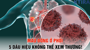 Máu Đông Ở Phổi 5 Dấu Hiệu Không Thể Xem Thường!