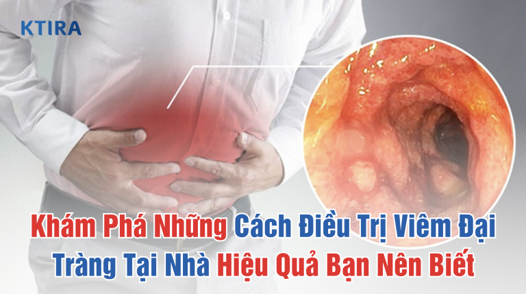 Khám Phá Những Cách Điều Trị Viêm Đại Tràng Tại Nhà Hiệu Quả Bạn Nên Biết