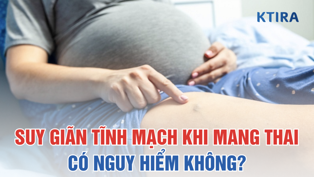 suy giãn tĩnh mạch khi mang thai có nguy hiểm không? KTIRA