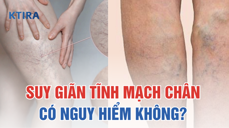 Suy Giãn Tĩnh Mạch Chân Có Nguy Hiểm Không? Cảnh Báo Những Biến Chứng Không Thể Xem Nhẹ
