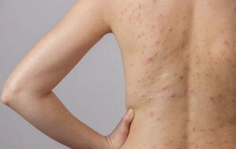 Ngứa ngáy toàn thân ban đêm