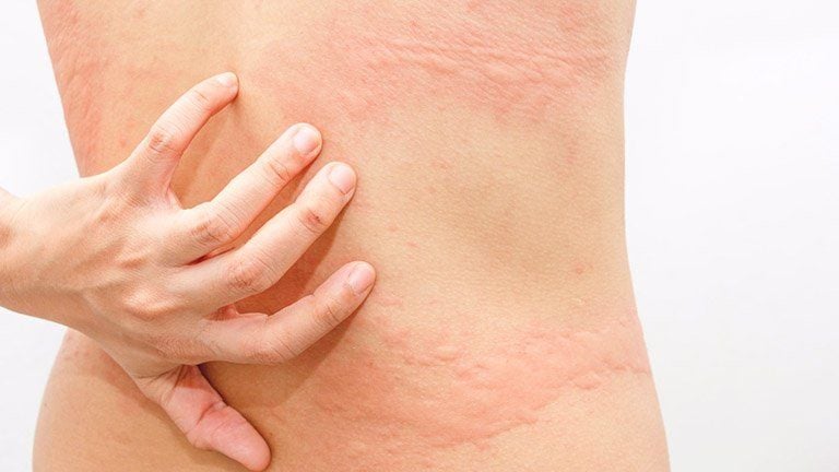 Ngứa ngáy toàn thân ban đêm
