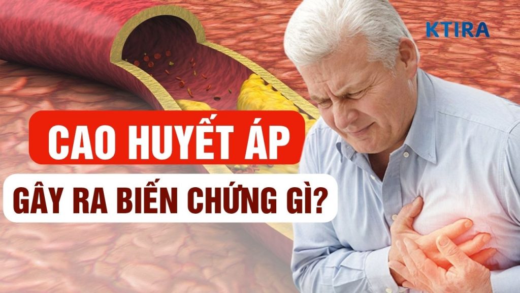 Cao huyết áp có thể gây ra biến chứng gì KTIRA