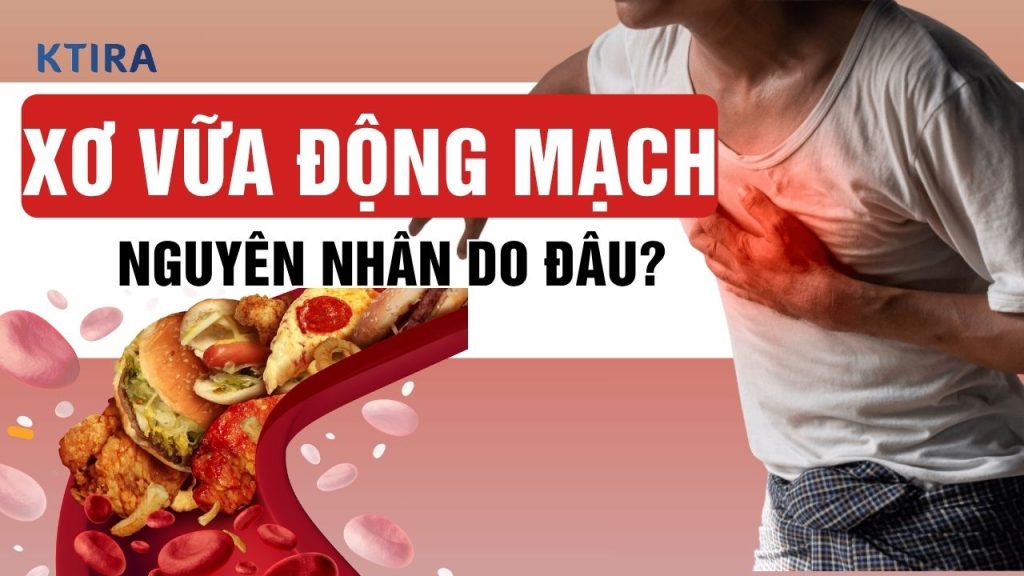 Nguyên Nhân Gây Ra Xơ Vữa Động Mạch