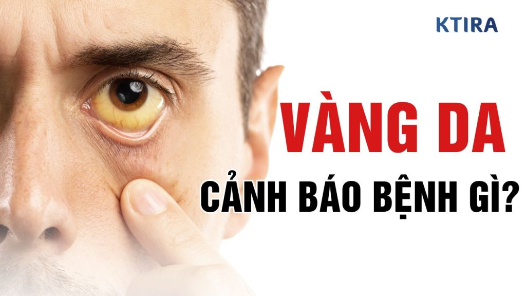 Vàng Da Là Dấu Hiệu Của Bệnh Gì?