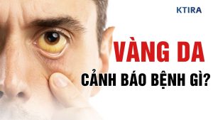 Vàng Da Là Dấu Hiệu Của Bệnh Gì?