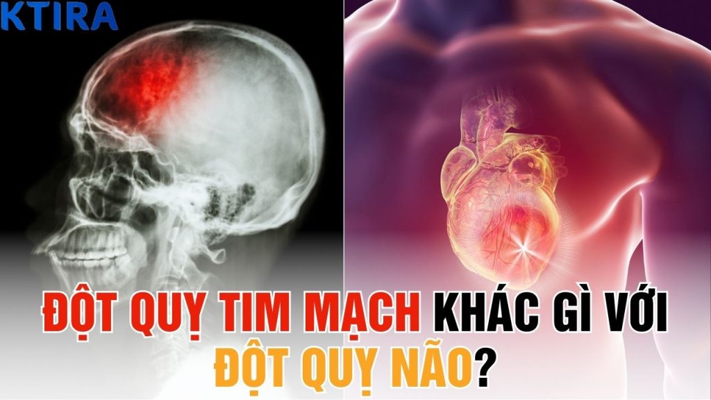 Đột Quỵ Tim Mạch Khác Gì Với Đột Quỵ Não?