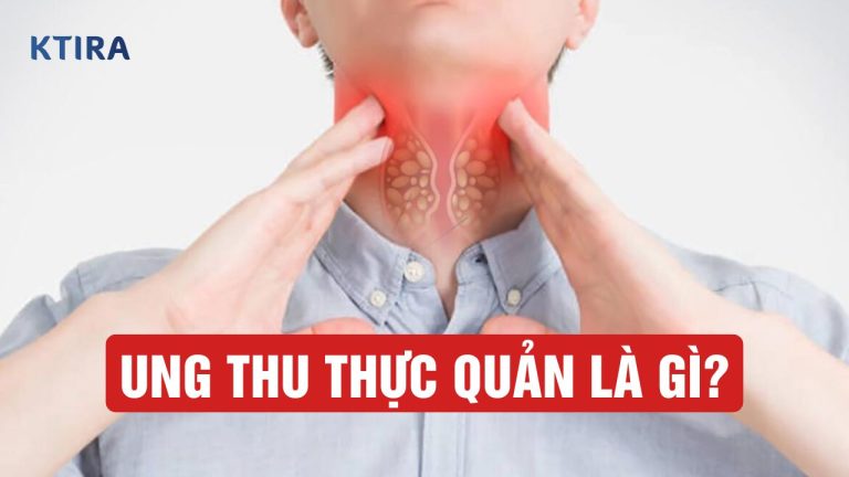 Ung Thư Thực Quản Là Gì? 3 Loại Phổ Biến Và Những Điều Bạn Cần Biết