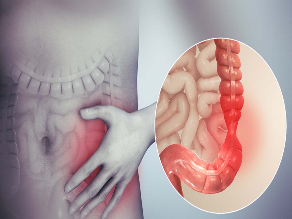 U đại tràng và mối nguy tiềm ẩn KTIRA 
