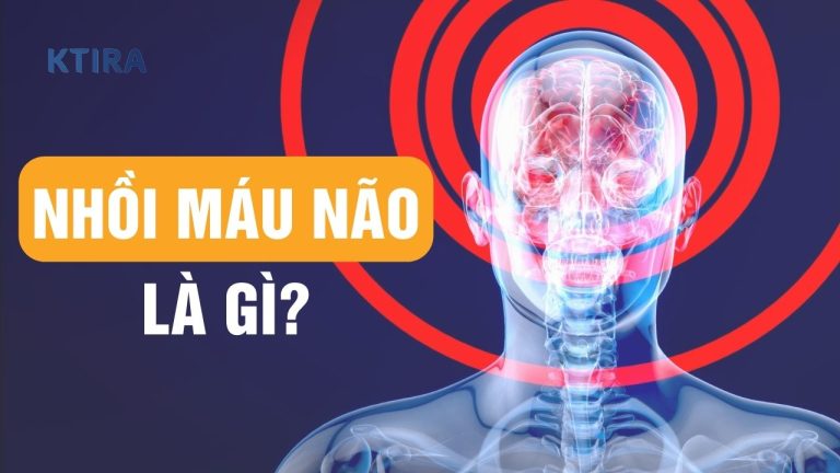 Nhồi Máu Não Là Gì? Kẻ Giết Người Thầm Lặng Và 5 Bí Quyết Phòng Ngừa
