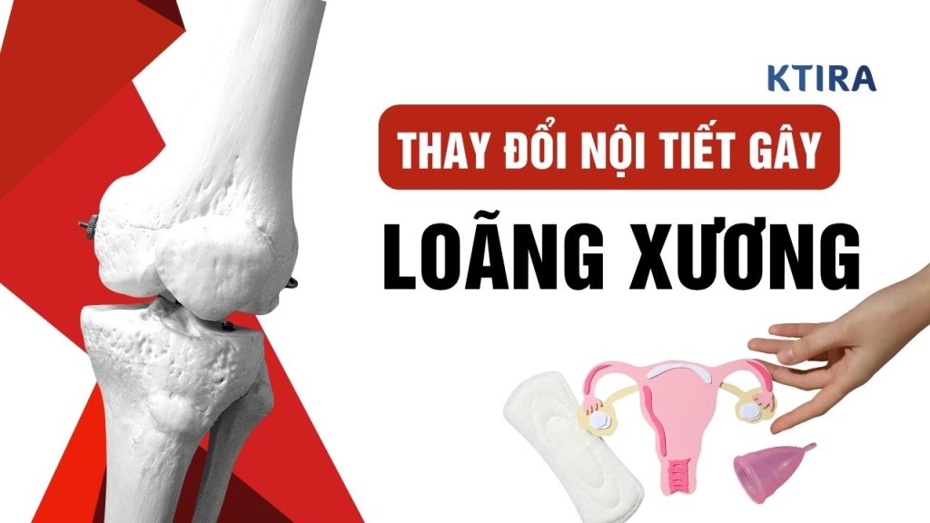 loãng xương do thay đổi nội tiết tố nữ
