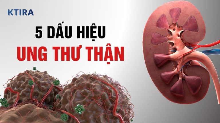 Ung Thư Thận: 5 Dấu Hiệu & Tiên Lượng Điều Trị!
