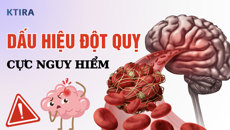 3 dấu hiệu đột quỵ cực nguy hiểm ai cũng phải biết