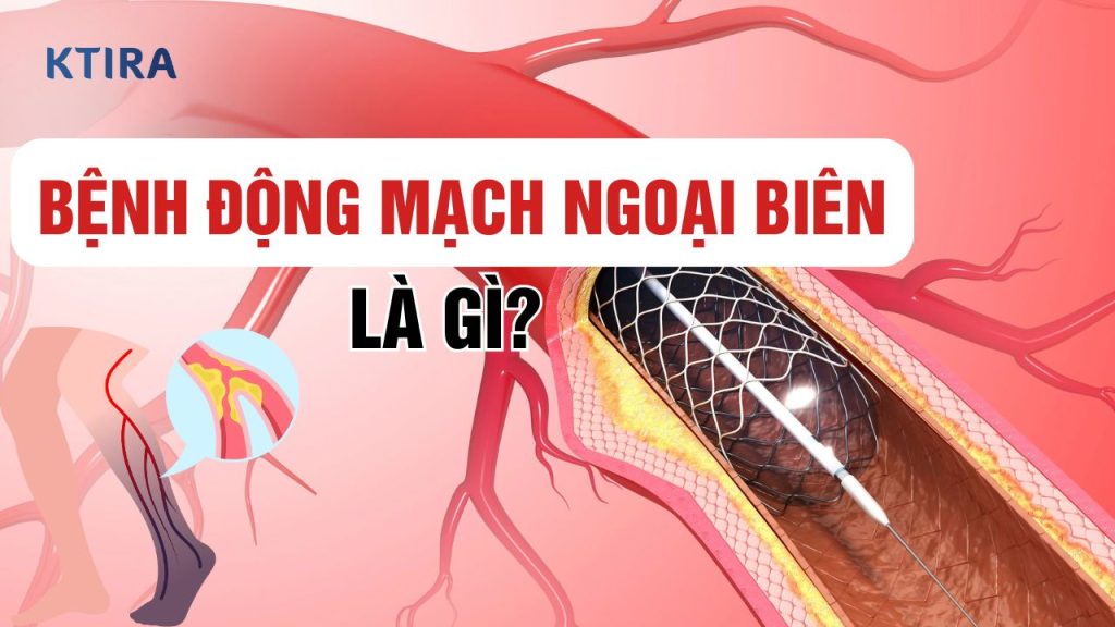 Bệnh Động Mạch Ngoại Biên