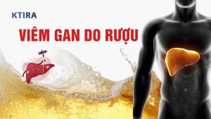 Viêm Gan Do Rượu Là Gì?