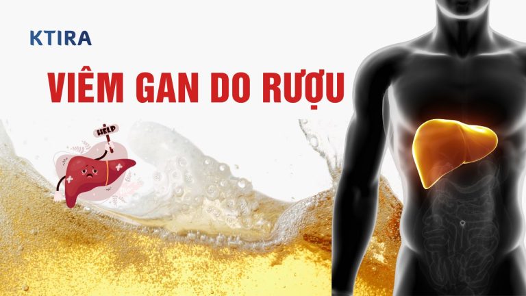 Viêm Gan Do Rượu Là Gì? 5 Triệu Chứng Có Thể Bạn Đang Mắc Phải!