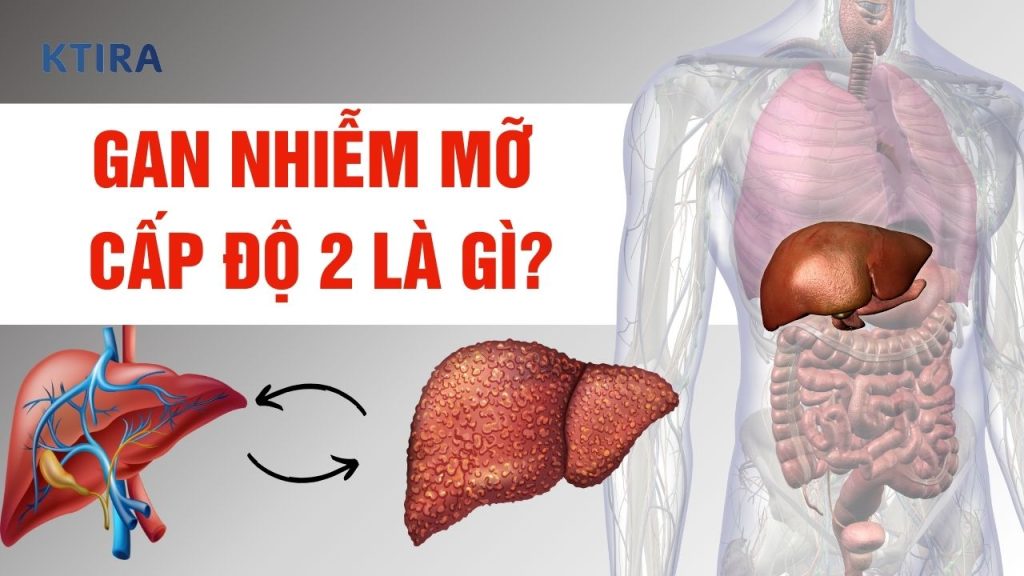 Gan nhiễm mỡ cấp độ 2 có nguy hiểm không?
