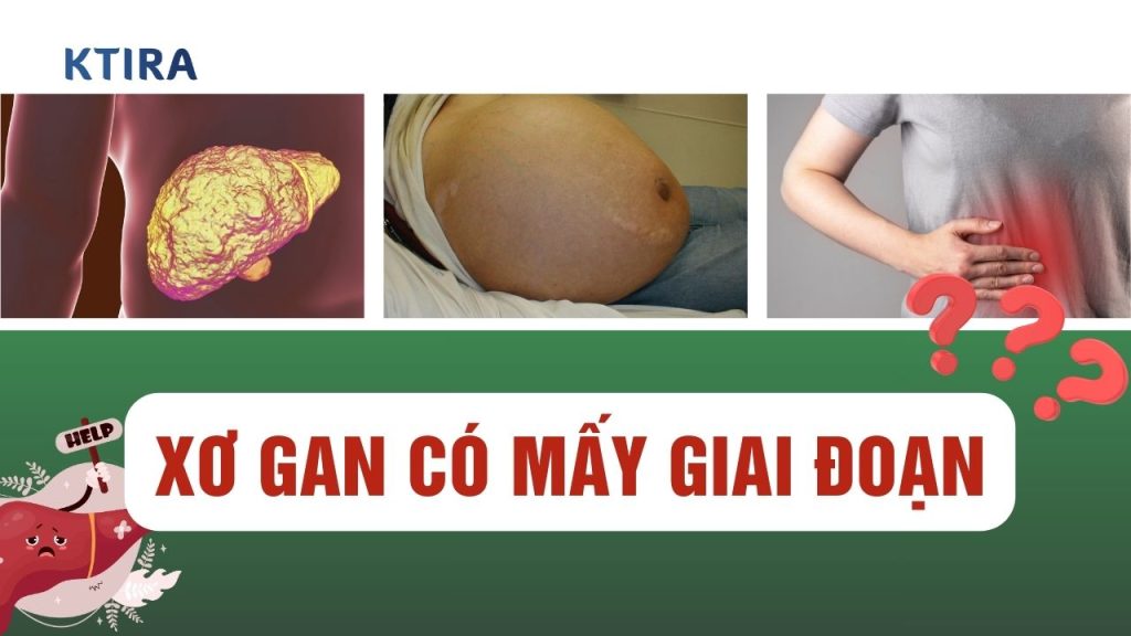 Xơ gan có mấy giai đoạn?
