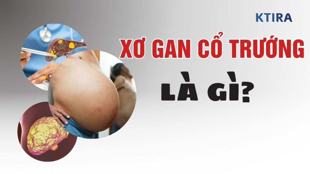 Xơ Gan Cổ Trướng Là Gì?
